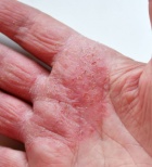 אקזמה בידיים - תמונת אווירה